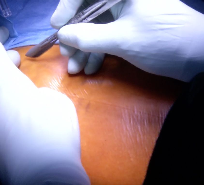 Live surgery reparto ortopedia – intervento femorale
