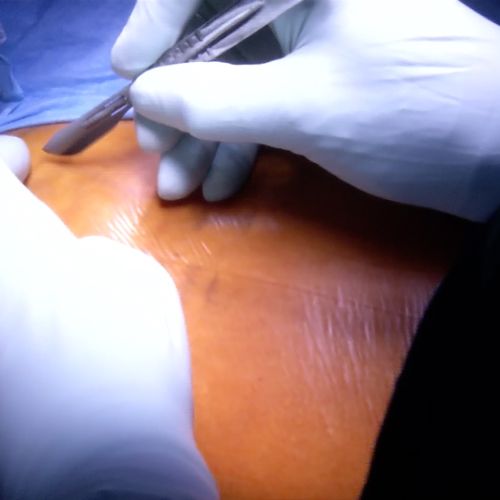 Live surgery reparto ortopedia – intervento femorale